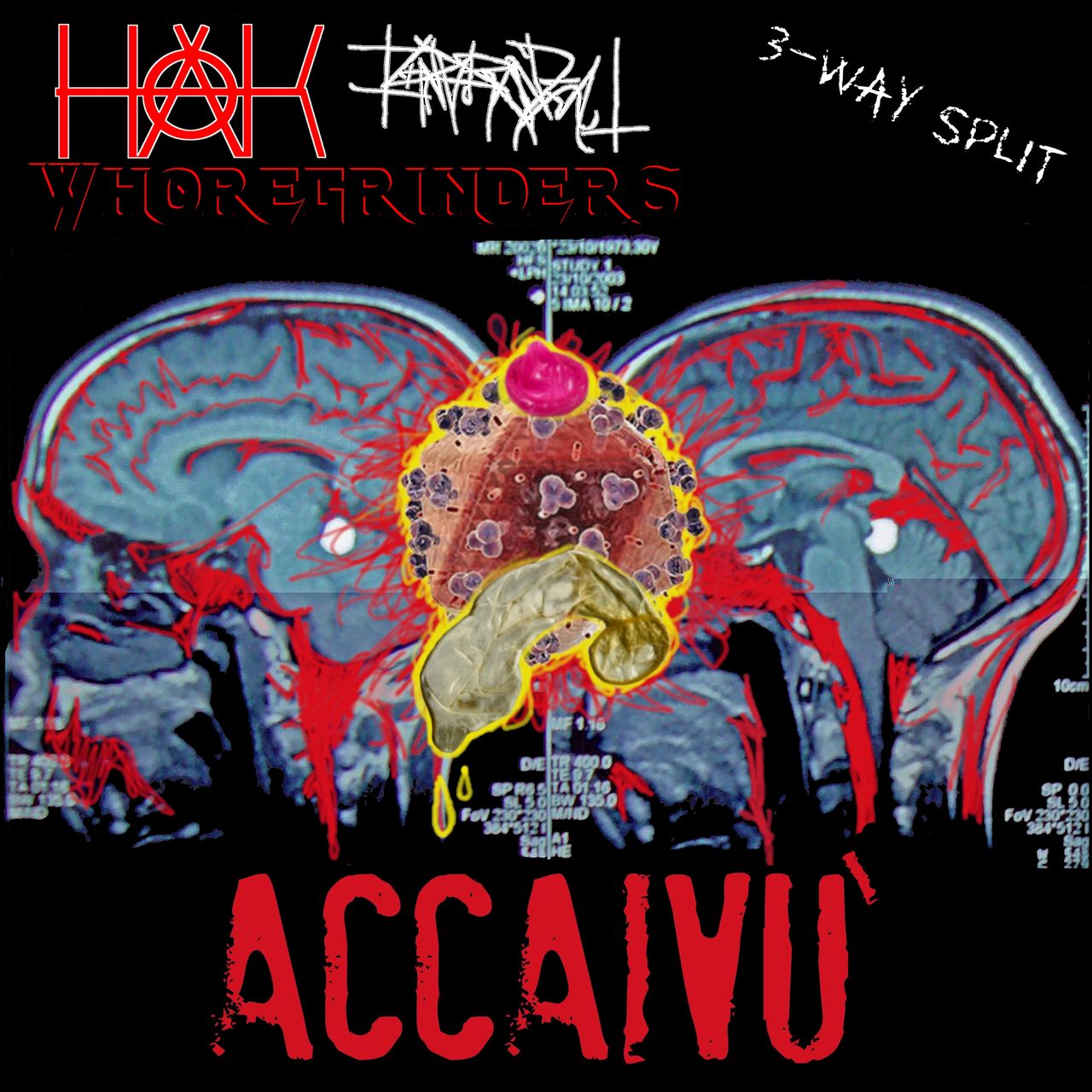 A dripping condom on top of an HIV virus on top of X-rays of a brain